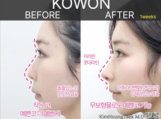 무보형물 코수술로도 오똑하고 예쁜 코 라인이 되는 경우
