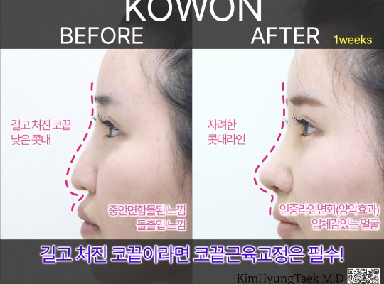 길고 처진코 코끝을 확실히 올리려면