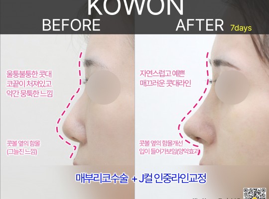 매부리코이면서 뭉툭한 복코, 전체적인 밸런스를 맞추는 포인트는?