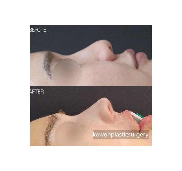복코·휜코 교정 및 실제거 코재수술 전후사진…