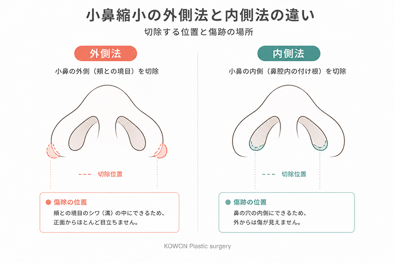 小鼻縮小の外側法と内側法で切除する位置と傷跡の場所の違いを示す鼻の底面図