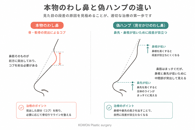 本物のわし鼻と偽ハンプ(鼻先が低いために段差が目立つ)の違いを示す側面シルエット比較図