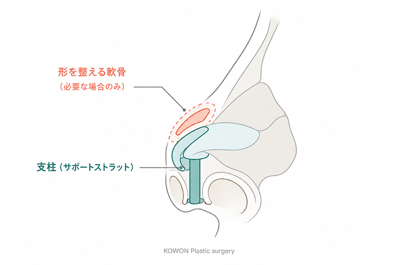 鼻柱に支柱を立てて鼻先を固定する鼻先軟骨移植の仕組みと、必要な場合に形を整える軟骨を重ねることを示す側面断面図