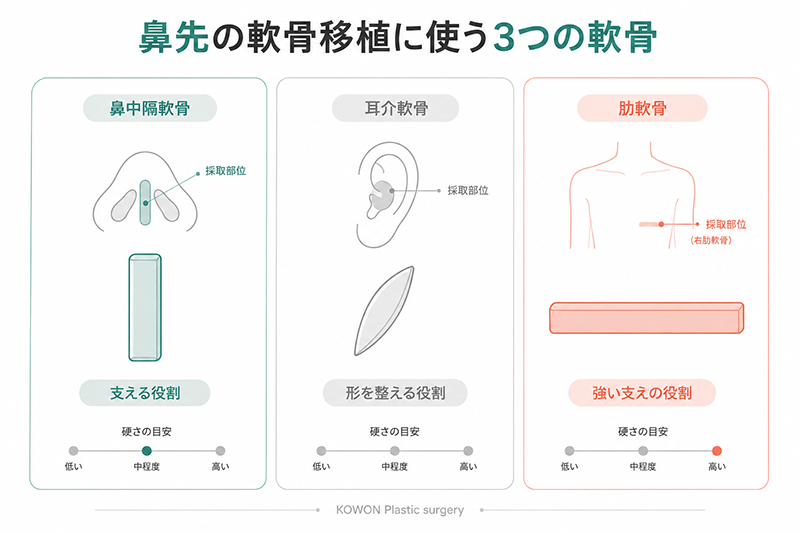 鼻先の軟骨移植に使う3つの軟骨(鼻中隔軟骨・耳介軟骨・肋軟骨)の採取部位と役割の違いを示す比較図