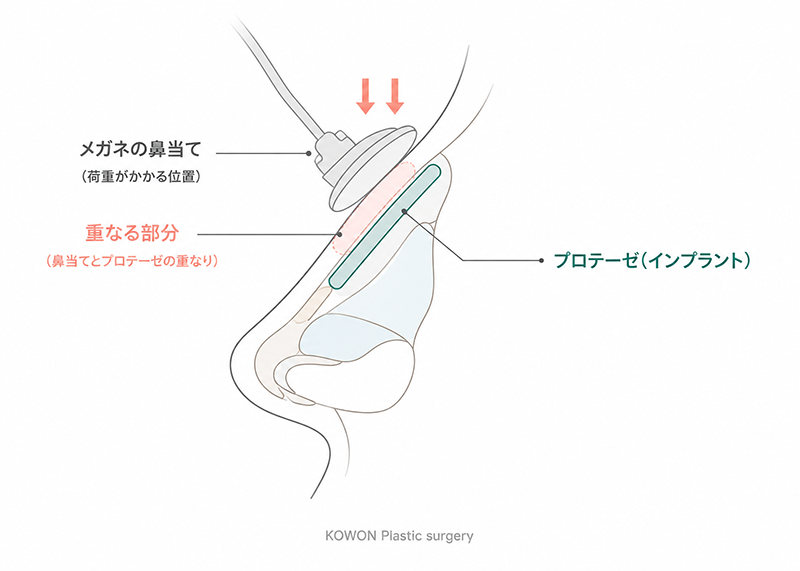 メガネの鼻当てが当たる位置と、鼻筋に入れたプロテーゼの位置が重なることを示す側面断面図