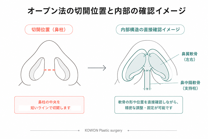 オープン法で鼻柱に加える切開の位置と、内部の軟骨構造を直接確認しながら手術できることを示す図