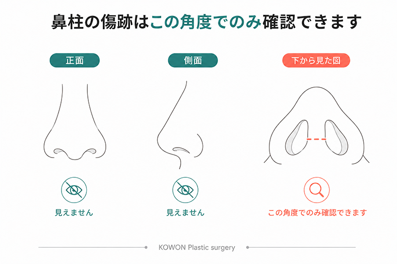 鼻柱の傷跡が正面や側面からは見えず、下から見上げた角度でのみ確認できる位置にあることを示す図