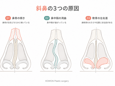 斜鼻の3つの原因(鼻骨の傾き・鼻中隔の湾曲・軟骨の左右差)を示す正面断面の解剖図