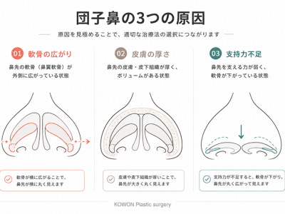 団子鼻の3つの原因(軟骨の広がり・皮膚の厚さ・支持力不足)を示す鼻先断面の比較図