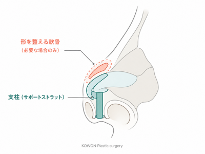 鼻柱に支柱を立てて鼻先を固定する鼻先軟骨移植の仕組みと、必要な場合に形を整える軟骨を重ねることを示す側面断面図