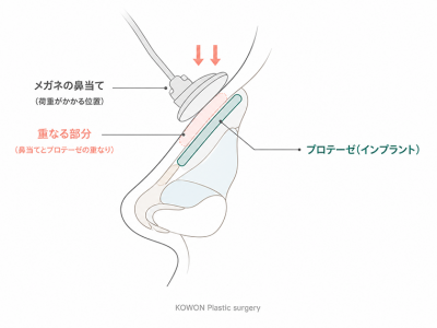 メガネの鼻当てが当たる位置と、鼻筋に入れたプロテーゼの位置が重なることを示す側面断面図