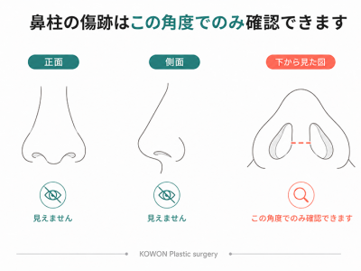 鼻柱の傷跡が正面や側面からは見えず、下から見上げた角度でのみ確認できる位置にあることを示す図