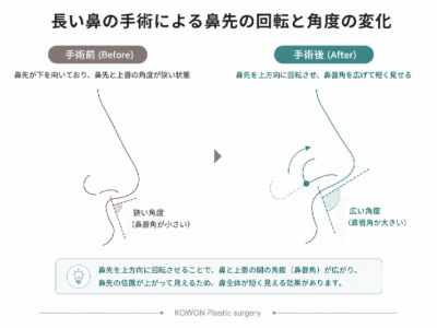 長い鼻の手術で下を向いた鼻先を回転させて持ち上げ、鼻先と上唇の間の角度を変えることで短く見せる仕組みを示す側面図